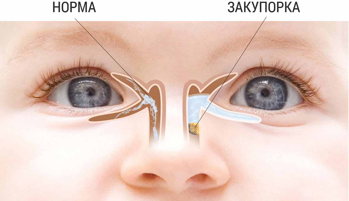 Как закапать капли в глаза ребенку правильно
