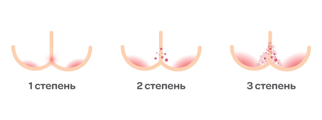 Как ухаживать за кожей малыша летом: лечение опрелостей, потницы и дерматита