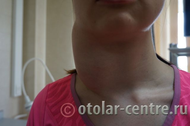 Шишка на шее у ребенка — причины появления уплотнения