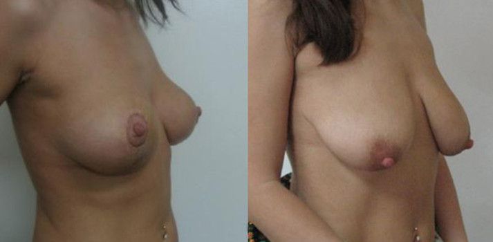 Красивая грудь после родов: это реально?