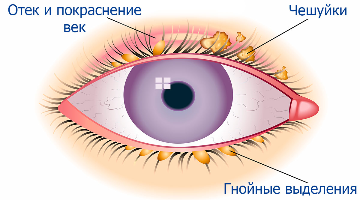 Корочки на бровях у грудничка — как убрать