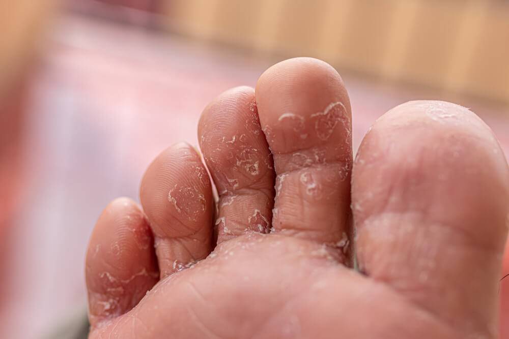 ᐈ грибок на ногах у детей: симптомы, причины и способы лечения