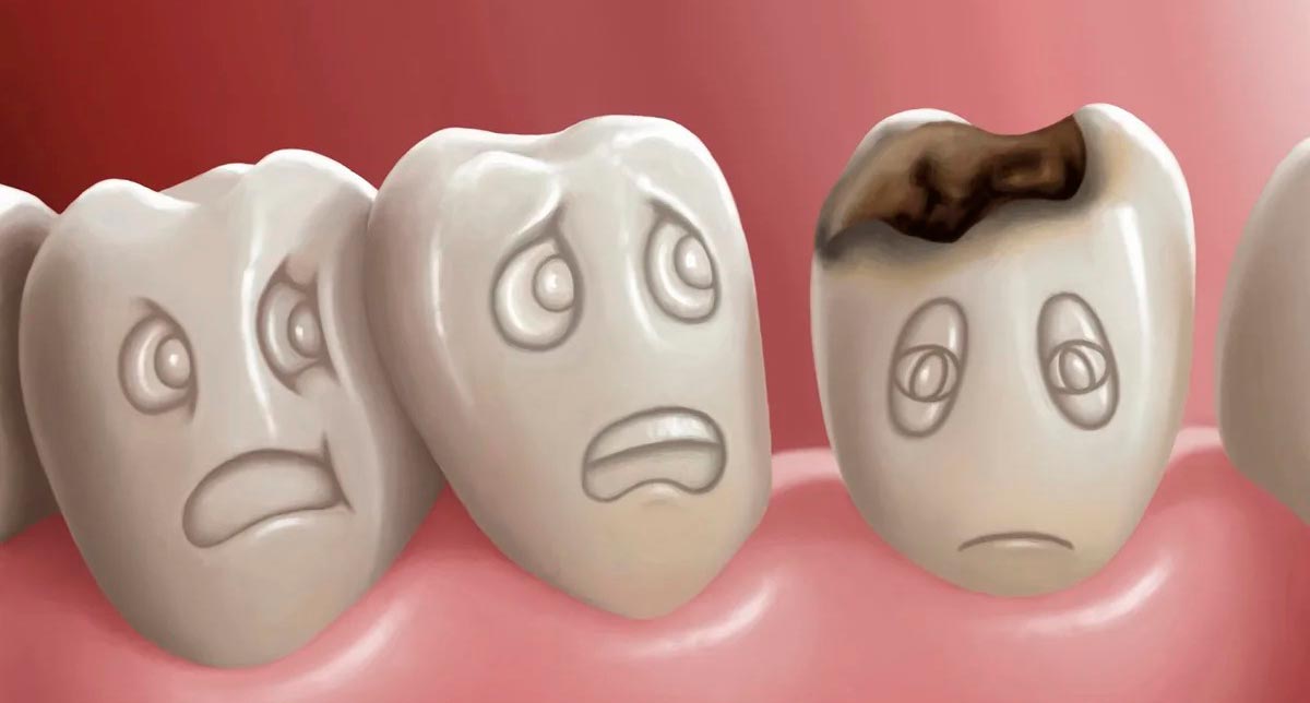 Видео: кариес молочных зубов – почему это опасно для вашего ребенка