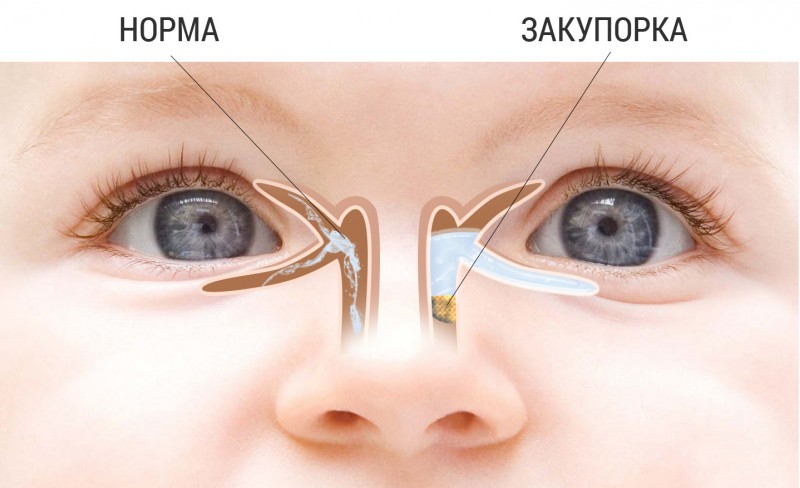 Массаж слезного канала у новорожденных — как массировать глаза грудничку