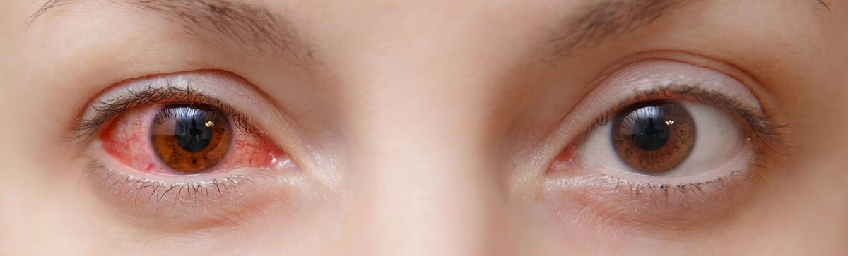 Капли и мази от конъюнктивита для детей до года