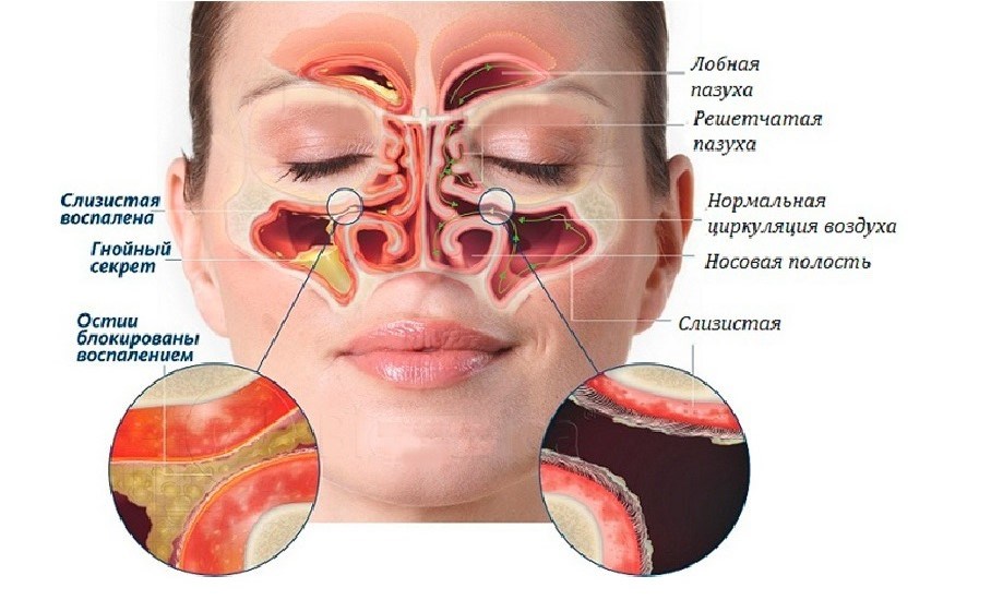 Отсасыватель соплей для новорожденных — как убрать сопли у грудничков