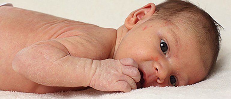 Шершавая кожа у ребенка на руках, ногах, теле — возможные причины