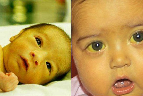 Когда у малыша пройдет младенческая желтуха? | детская городская поликлиника № 32