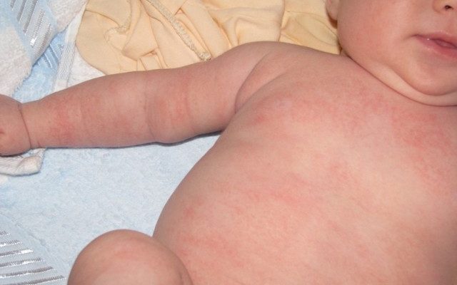 Сыпь на лице у ребенка — что это такое, виды высыпаний
