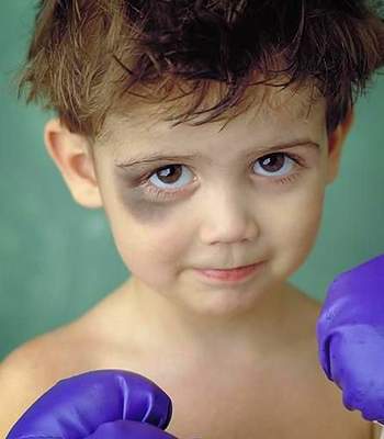 Почему у ребенка синие круги под глазами — тревожные симптомы