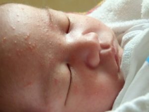 Акне новорожденных (прыщики). Как не спутать с аллергией