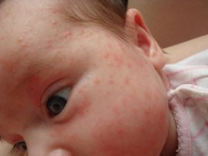 Сыпь на лице и на голове новорожденного — что это такое