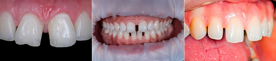 Могут ли в 2 месяца резаться зубы у грудничков