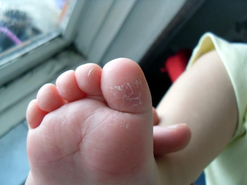 Трещины на ступнях — причины и лечение | центр подологии и остеопатии татьяны красюк