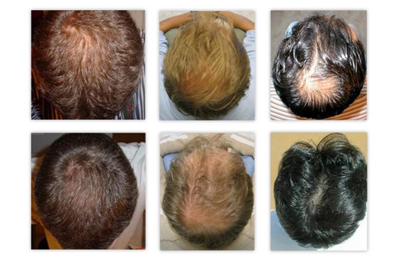 Почему у подростка выпадают волосы? – публикации – лаборатория ан-тек