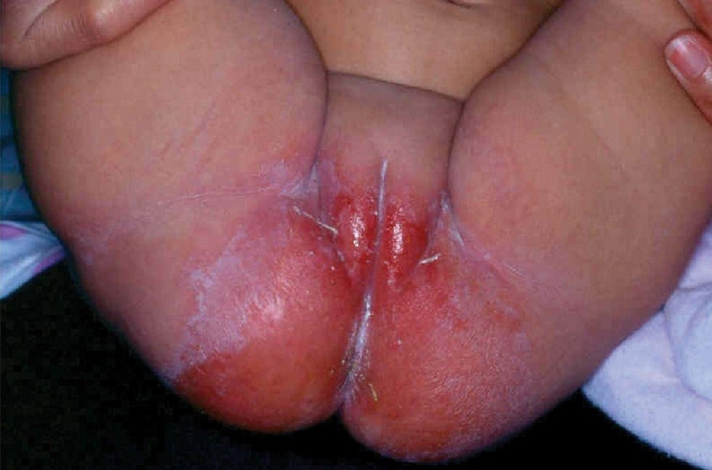 Что такое пеленочный дерматит и как его лечить