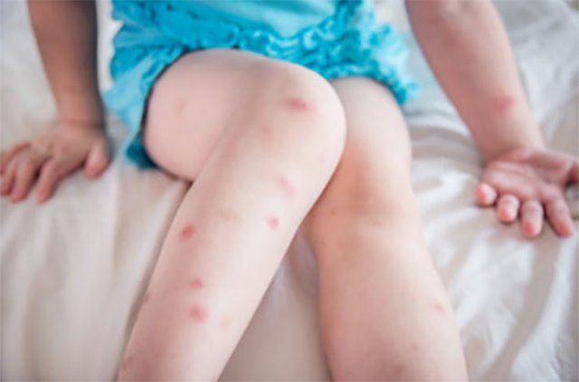 От чего сыпь на ногах у ребенка младше года — возможные причины