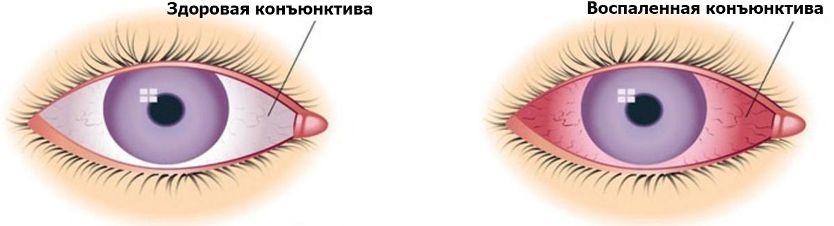 Капли и мази от конъюнктивита для детей до года