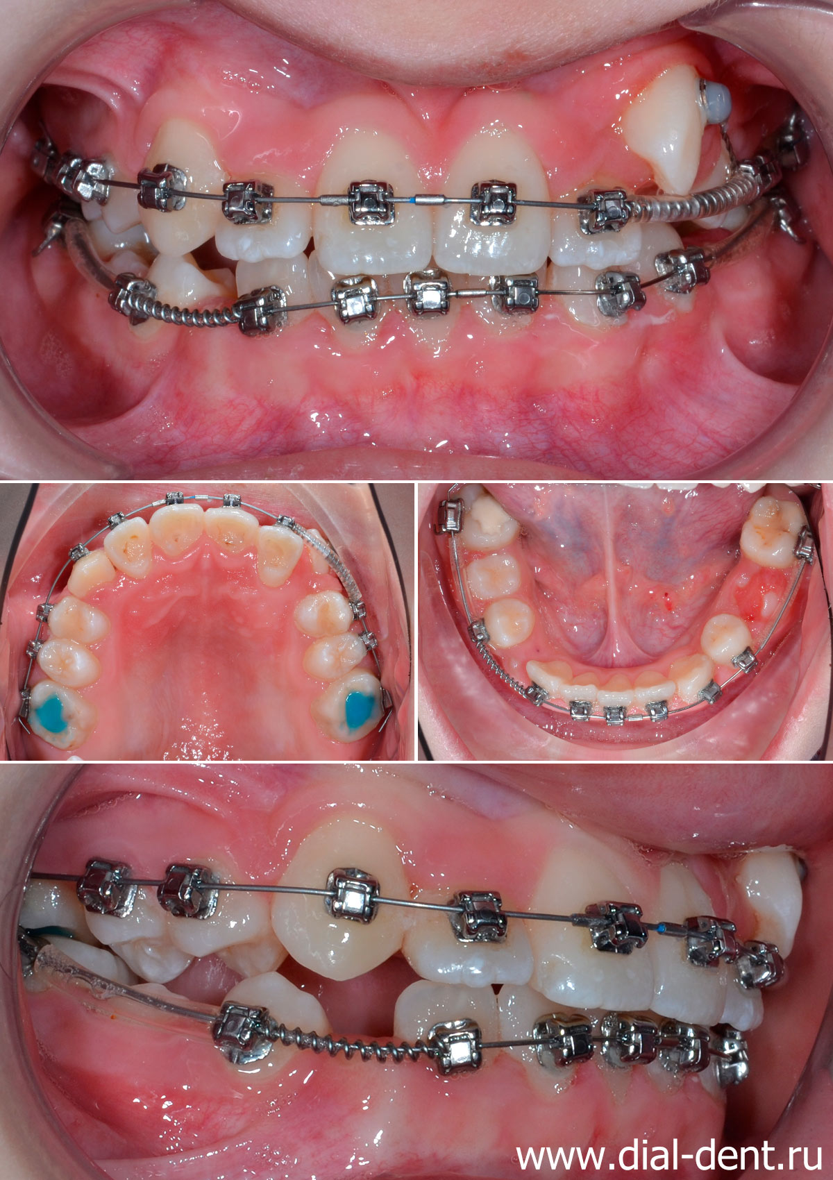 Сопутствующие проблемы при прорезывании зубов
