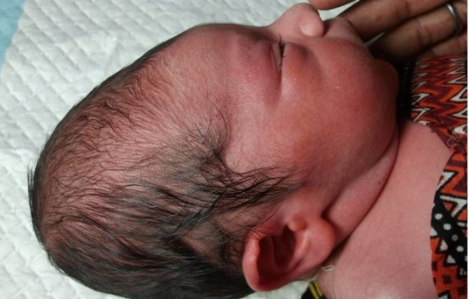 Почему у новорожденного ребенка большой, выпуклый лоб