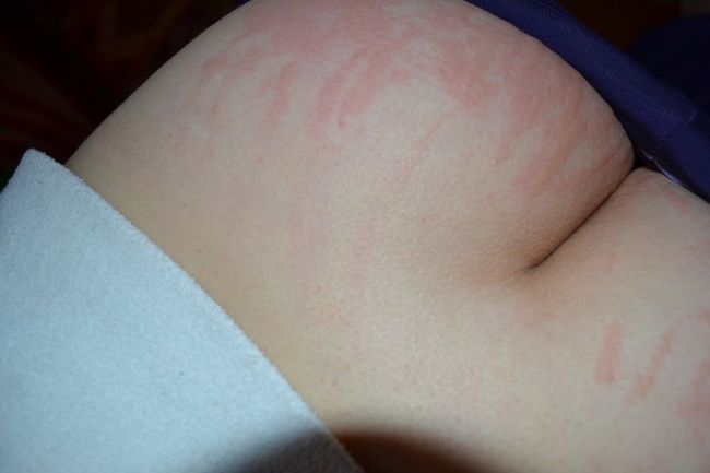 Облазит кожа на пальцах рук у ребенка — причины