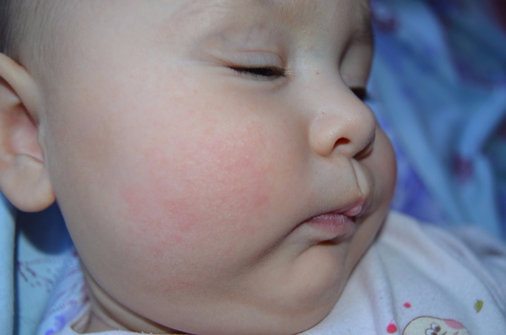 Аллергическая сыпь у новорождённых и грудничков