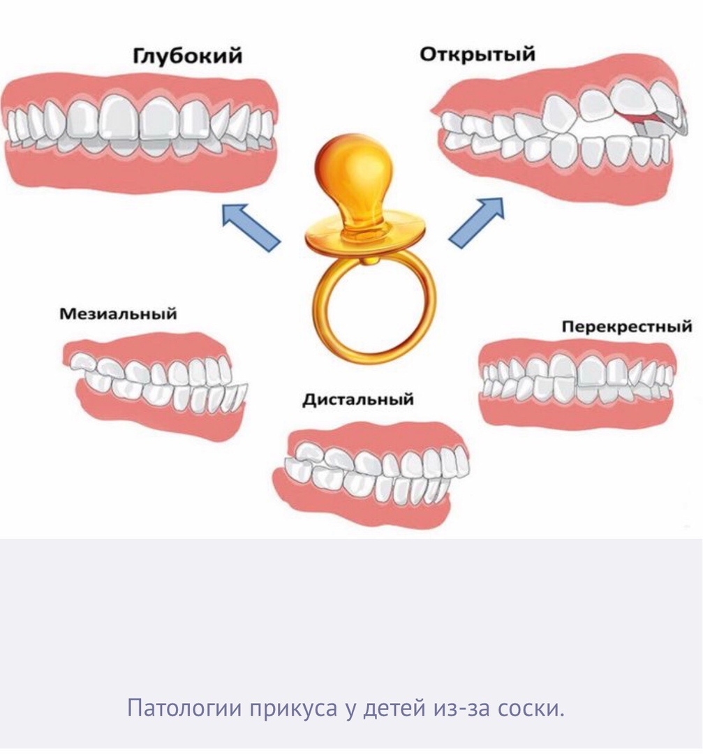 Прикус у детей от пустышки