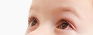 Лопнул сосуд в глазу у ребенка — возможные причины, что делать