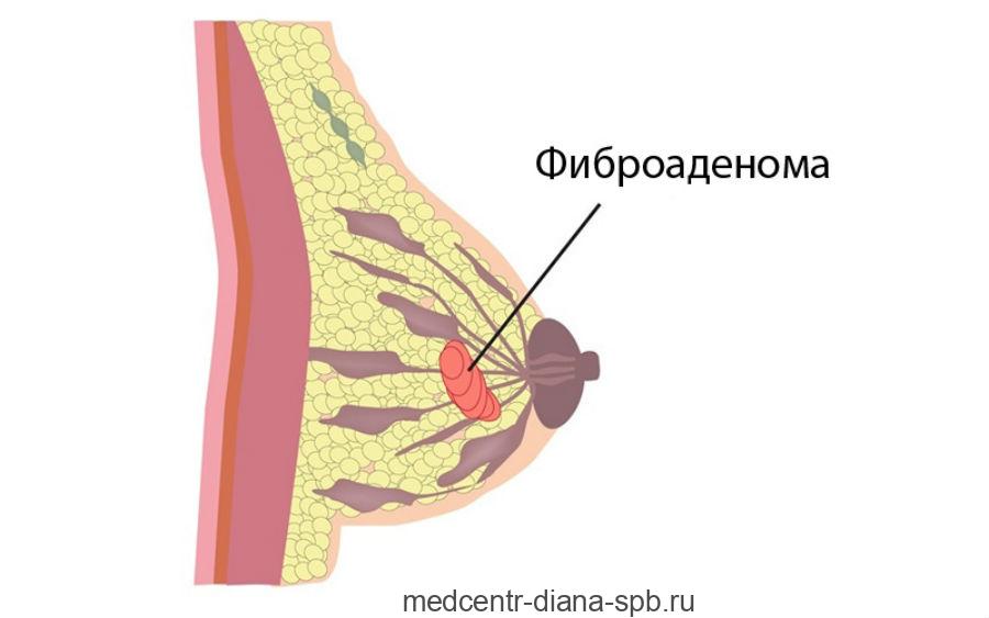 Покалывание в груди при грудном вскармливании: что делать?